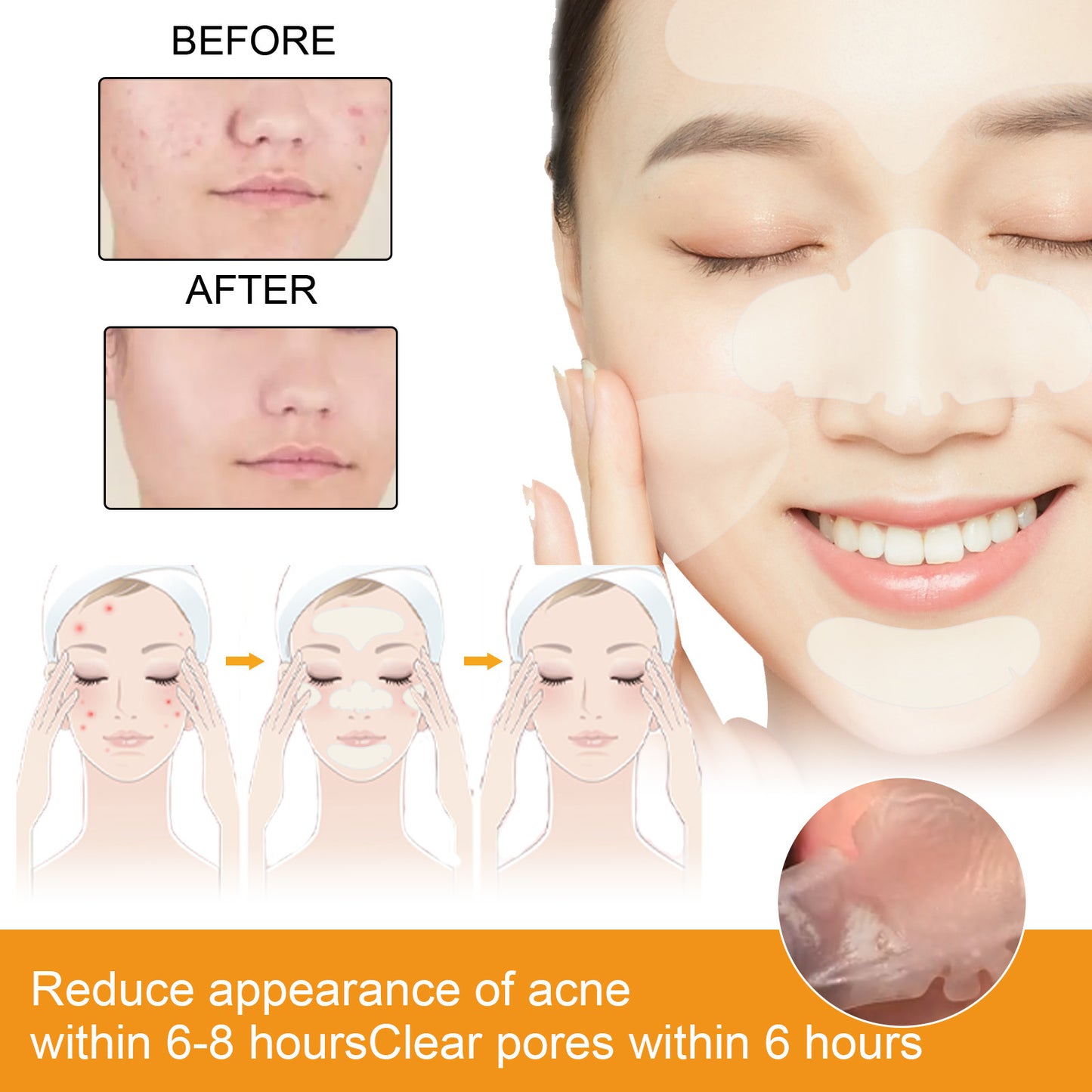 The nose acne patch