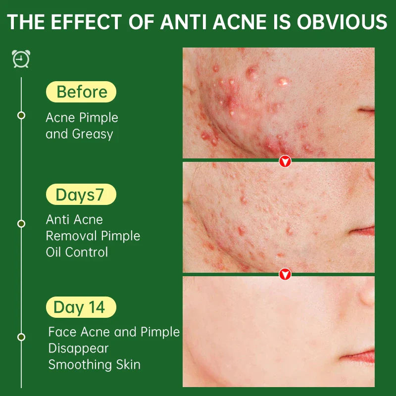 Herbal Acne Cream