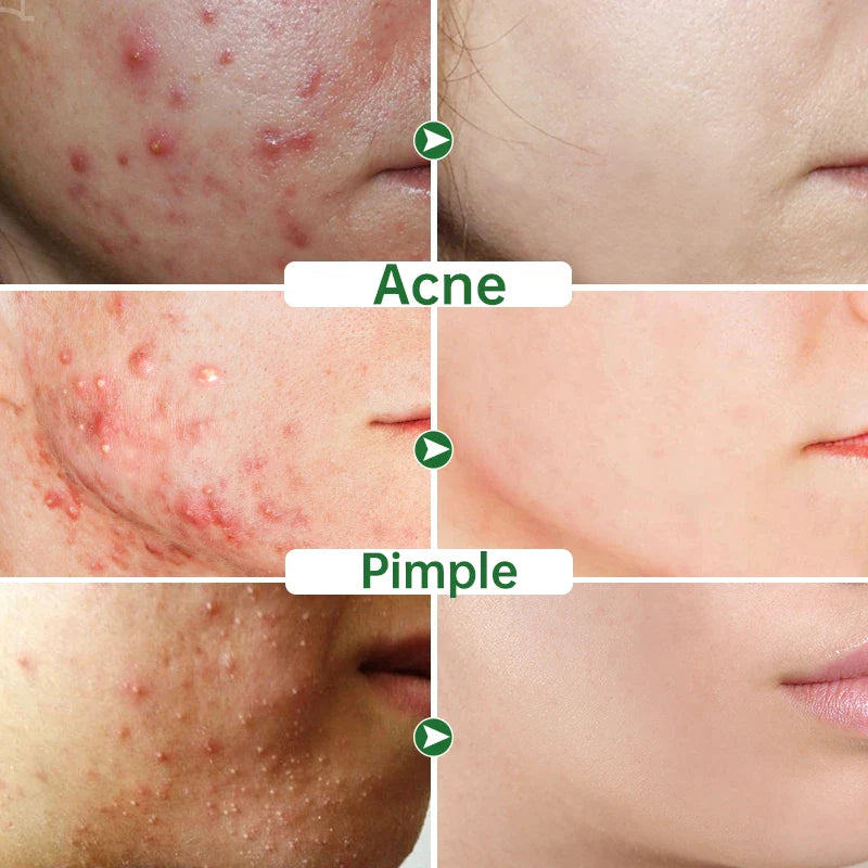 Herbal Acne Cream