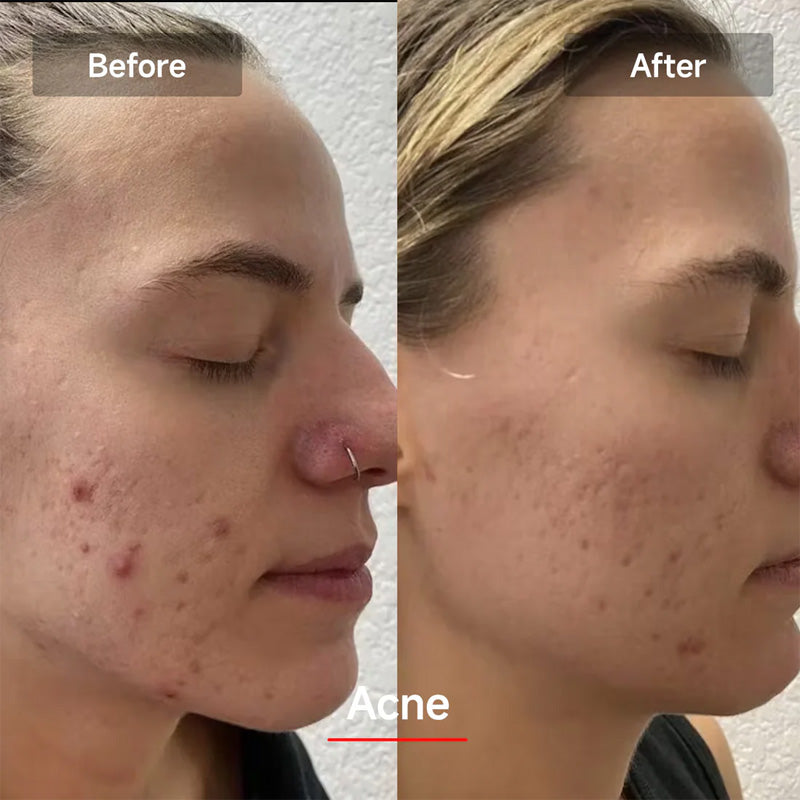 Silicone photorejuvenation beauty instrument