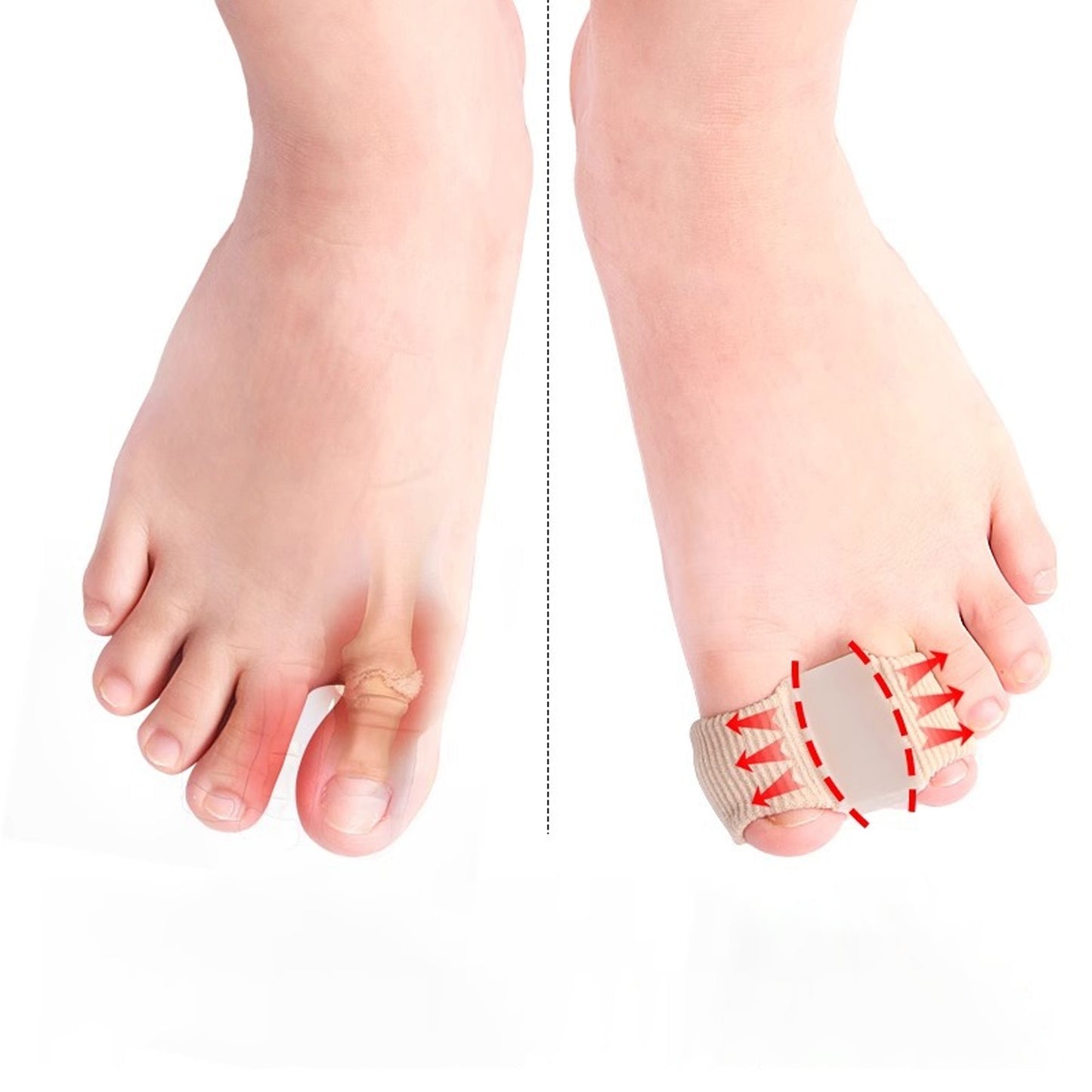 Hallux valgus corrector